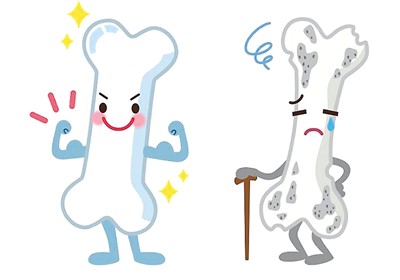 骨質(zhì)疏松重在早篩早防